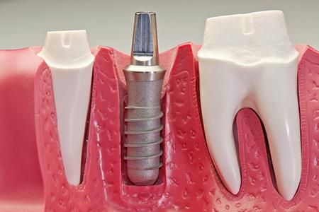 Rodental Laboratorio Dental implante-dental
